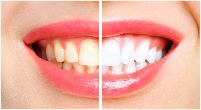 Professional Teeth Whitening