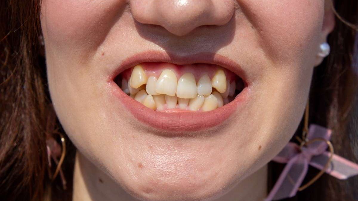 Top 7 Effects of Crowded Teeth You Shouldn’t Ignore