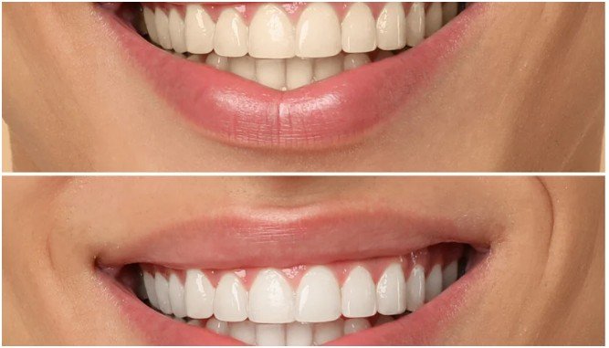 Composite Bonding for Stain Coverage