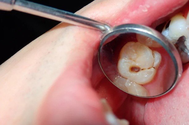 Preventing Tooth Decay Before It Starts